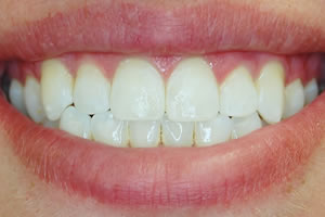 forte-after