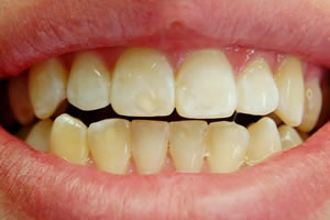 forte-before